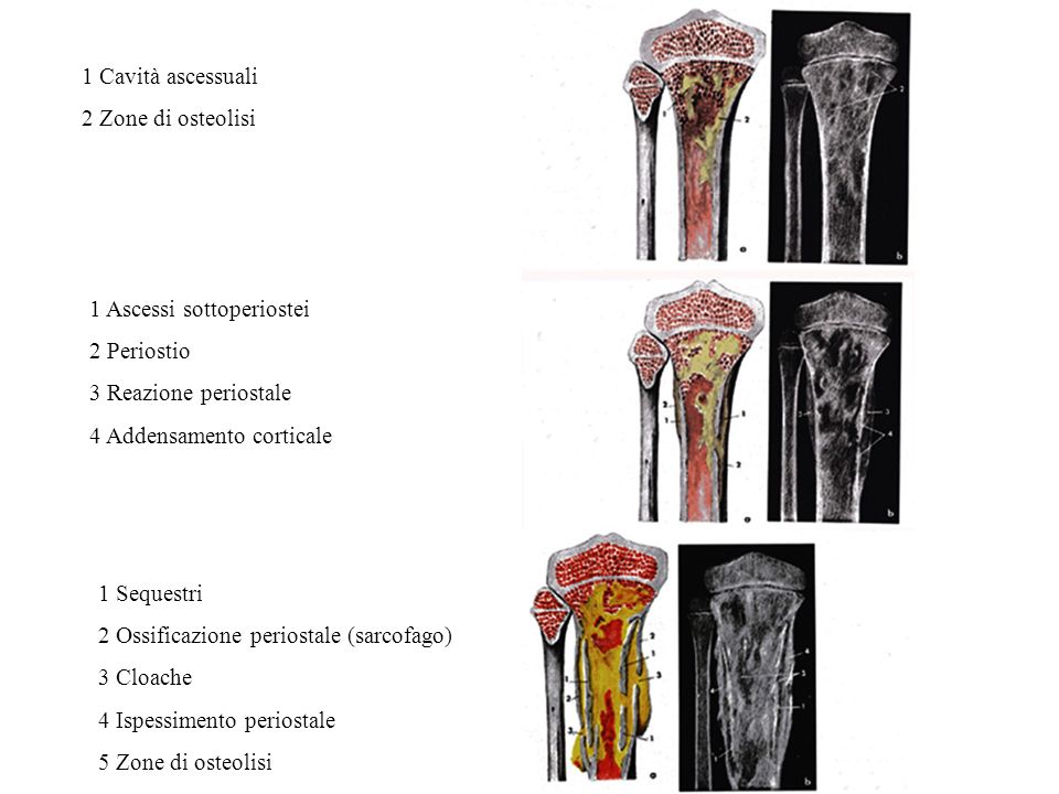 ALTERAZIONI INFIAMMATORIE OSSEE OSTEOMIELITE ppt scaricare